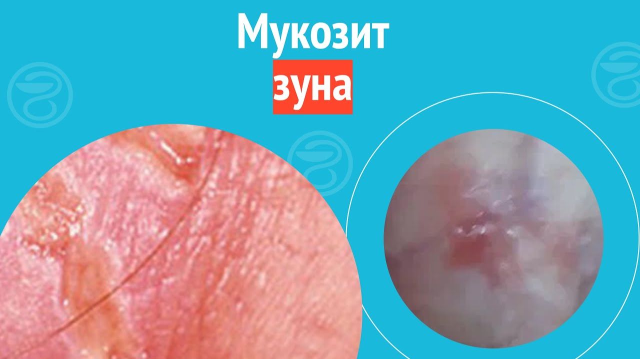 🙄 Мукозит зуна. Клинический случай №1508 смотреть онлайн
