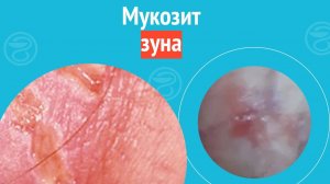 🙄 Мукозит зуна. Клинический случай №1508