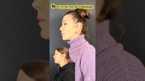 Эндоскопическая подтяжка средней трети лица