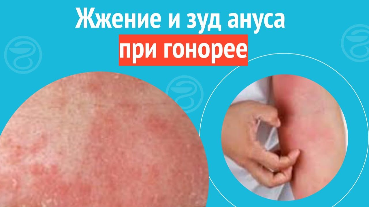 😒 Жжение и зуд ануса при гонорее. Клинический случай №1507 смотреть онлайн