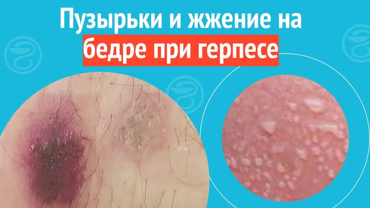 🦵 Пузырьки и жжение на бедре при герпесе. Клинический случай №1497 смотреть онлайн