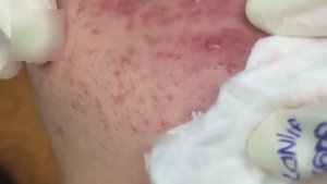 Выдавливание подкожных прыщей. Глубокое извлечение.