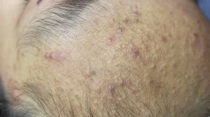 048 • Acne collection • АСМР • Relax Spa