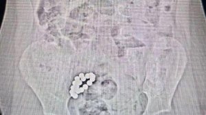 Проглотившего 19 магнитов мальчика спасли московские врачи.