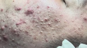 Выдавливание прыщей на лице! #комедоны #милиумы