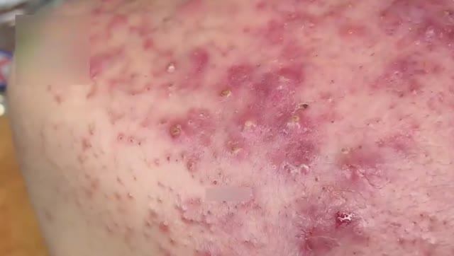 Очищение кожи от комедонов.