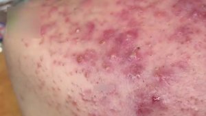 Очищение кожи от комедонов.