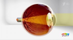 Дальнозоркость: помогут технология или врач? Жить здорово! Фрагмент выпуска от 31.03.2026