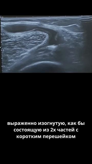 #киста Бейкера