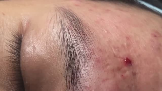 Удаление комедонов. Множество сюрпризов под кожей.