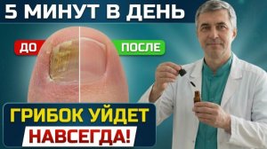 ГРИБОК СОЙДЁТ СЛОЯМИ! Если перестанете делать ЭТО... Рецепт от Грибка в домашних условиях!