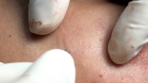 Подкожные прыщи трудно удалять. #акне #закрытыекомедоны #глубокоеакне #лечениеакне