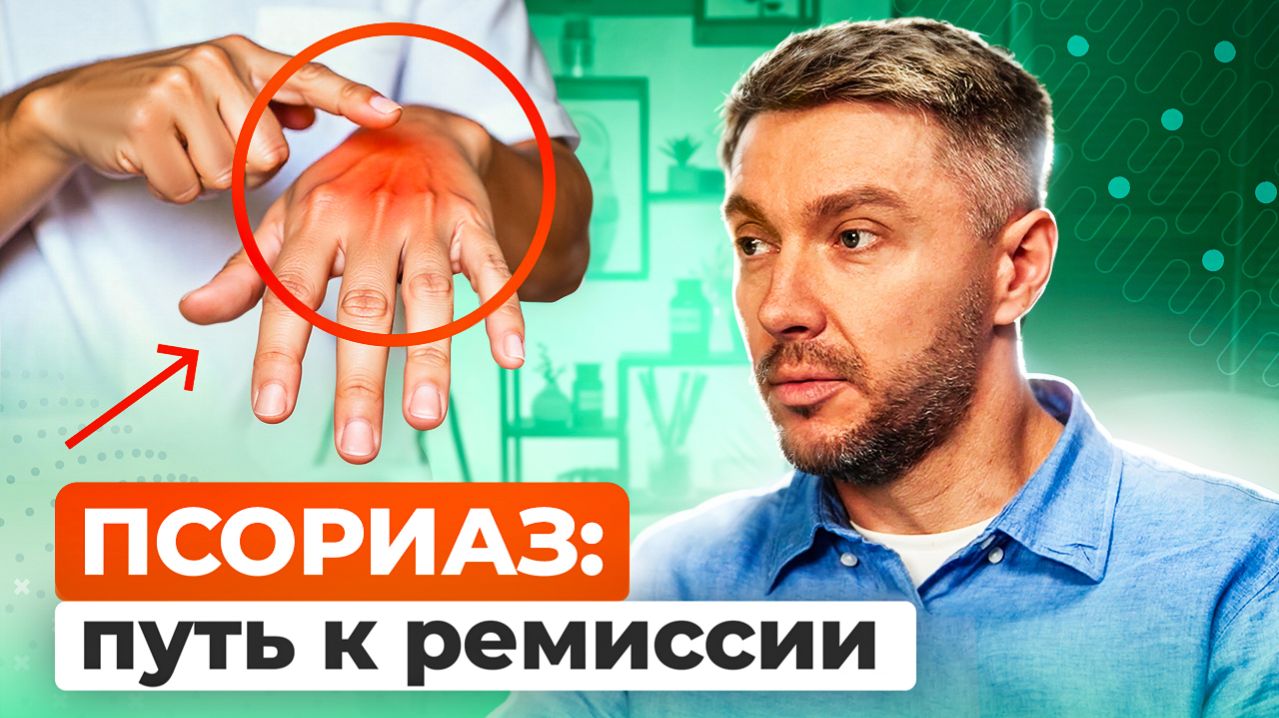 ПСОРИАЗ: разбор лечения, симптомы, главные мифы про псориаз