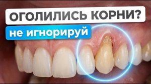 ОПУСТИЛАСЬ ДЕСНА? Вот что НУЖНО СДЕЛАТЬ /Стоматология Маэстро Улыбок