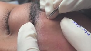 Глубокое очищение проблемной кожи от акне.