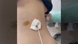 Перевязка нефростомы