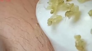 #219 Чистка лица от угрей и акне. Выдавливание прыщей. Удаление черных точек и комедонов