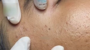 Выдавливание кистозных прыщей. Тяжёлый случай.