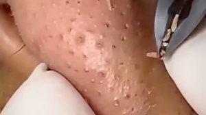 #218 Чистка лица от угрей и акне. Выдавливание прыщей. Удаление черных точек и комедонов