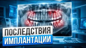 Кому НЕЛЬЗЯ ставить импланты? Стоматологи молчат об этом /Стоматология Маэстро Улыбок