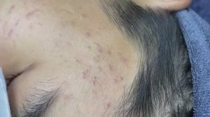 045 • Acne collection • АСМР • Relax Spa