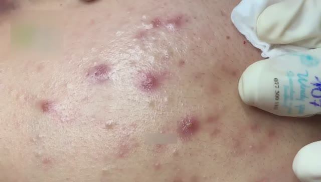 Удаление черных точек и комедонов