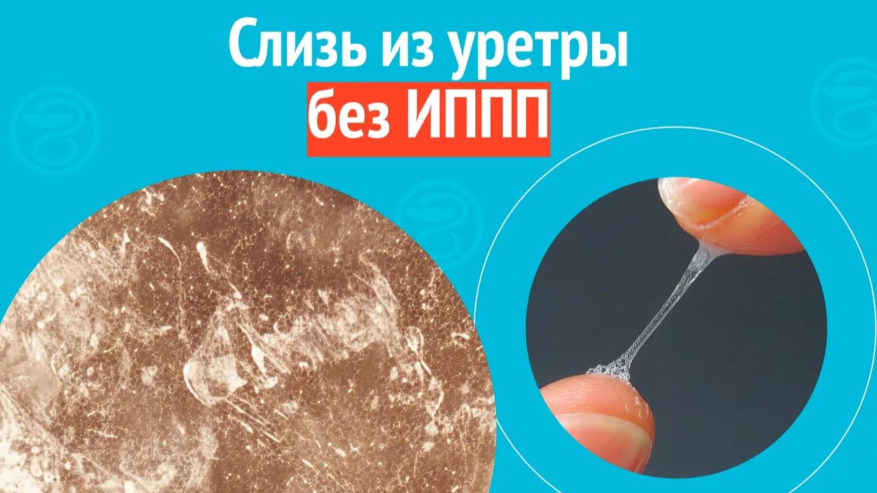 😥 Слизь из уретры без ИППП. Клинический случай № 1762 смотреть онлайн