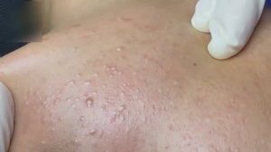 Чистка кожи от угревой сыпи. Рабочая схема.