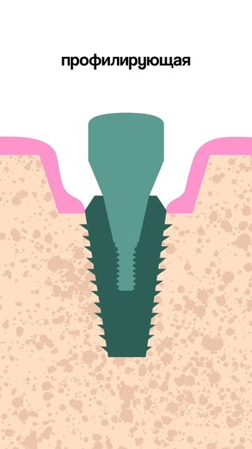 Профилирование кости