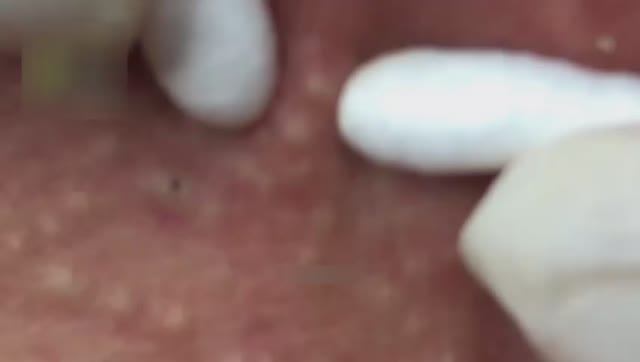 Удаление открытых и закрытых комедонов