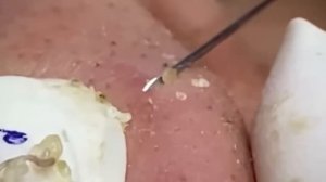 #221 Чистка лица от угрей и акне. Выдавливание прыщей. Удаление черных точек и комедонов