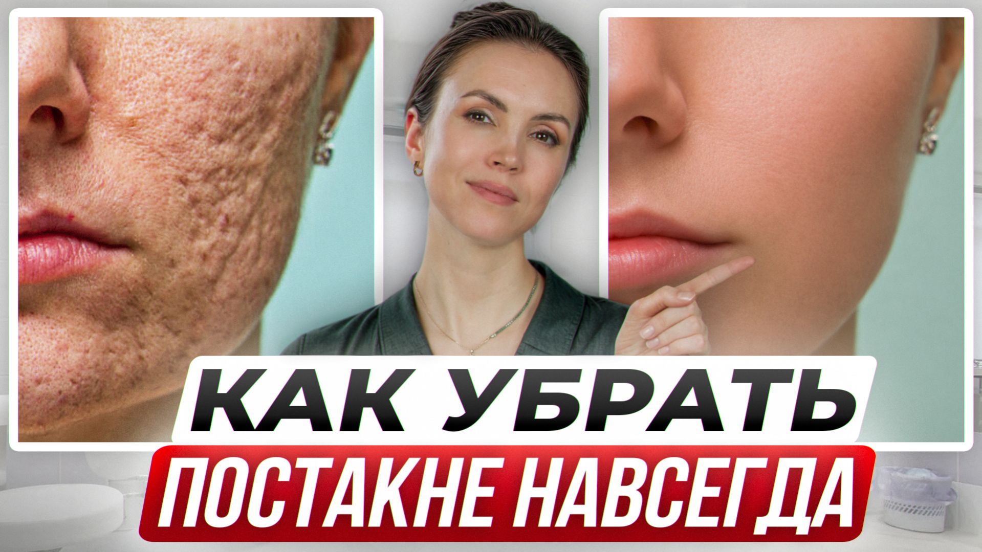 Как убрать ПЯТНА и РУБЦЫ после высыпаний? / Простой метод который работает