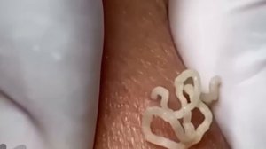 #220 Чистка лица от угрей и акне. Выдавливание прыщей. Удаление черных точек и комедонов