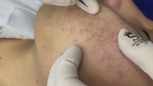 Профессиональное очищение как основа лечения угрей.