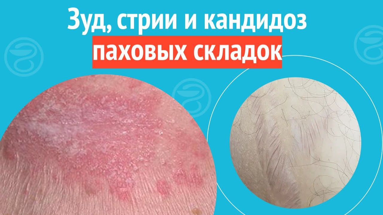 😰 Зуд, стрии и кандидоз паховых складок. Клинический случай №1522 смотреть онлайн
