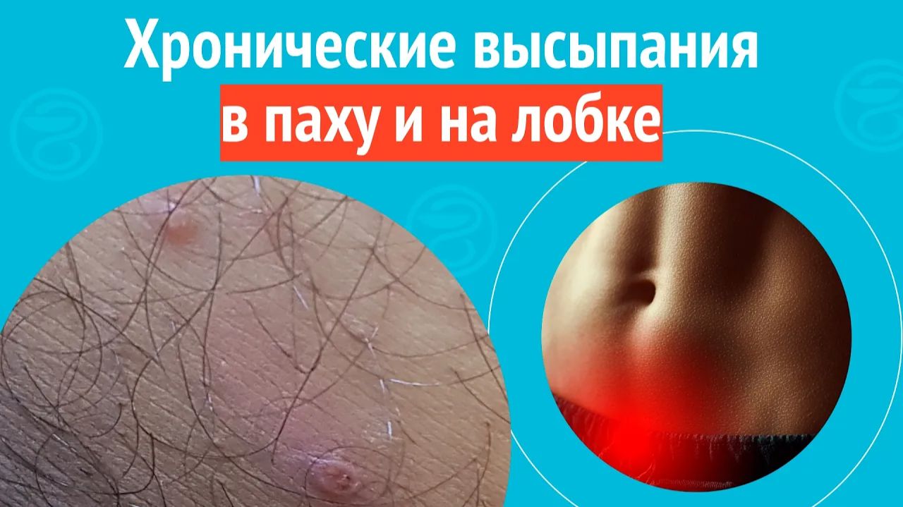 😦 Хронические высыпания в паху и на лобке. Клинический случай № 1764 смотреть онлайн