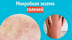 🦵 Микробная экзема голеней. Клинический случай № 1761
