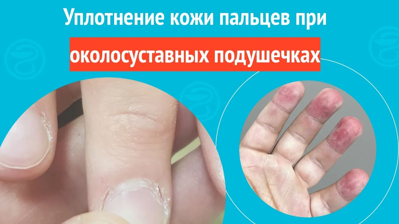 ✋ Уплотнение кожи пальцев при околосуставных подушечках. Клинический случай № 1763 смотреть онлайн