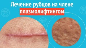 ✅ Лечение рубцов на члене плазмолифтингом. Клинический случай №1516