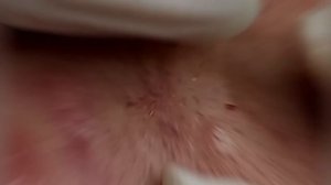 Выдавливание прыщей, угрей, черных точек и камедонов #320