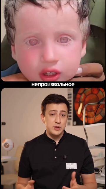 Альбинизм глаз