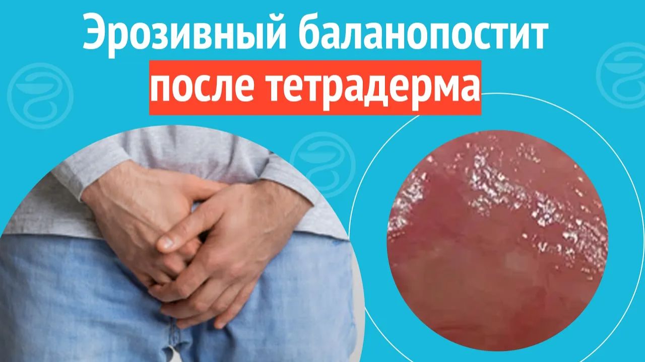 😠 Эрозивный баланопостит после тетрадерма. Клинический случай №1515 смотреть онлайн
