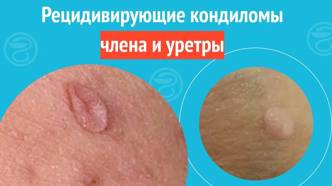 🫨 Рецидивирующие кондиломы члена и уретры. Клинический случай №1514 смотреть онлайн