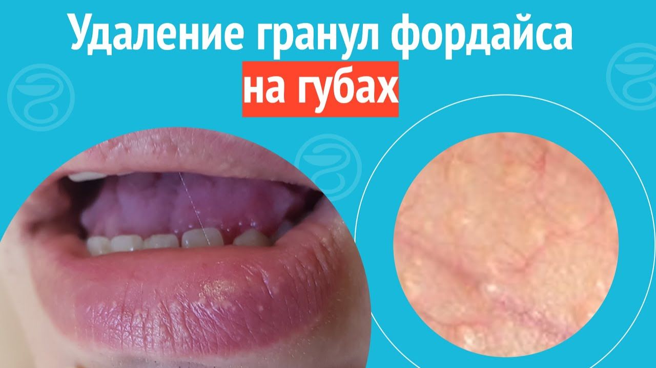 👄 Удаление гранул фордайса на губах. Клинический случай №1520 смотреть онлайн