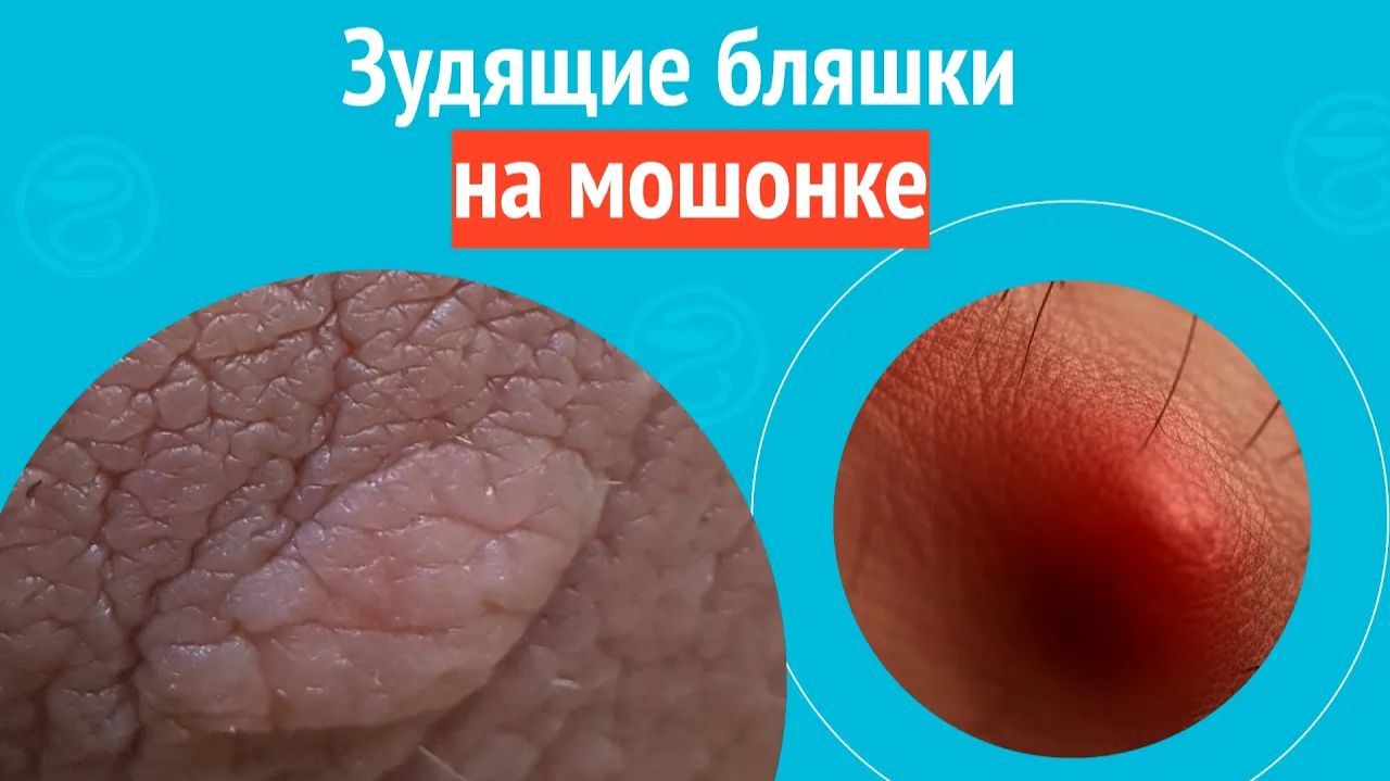 👉 Зудящие бляшки на мошонке. Клинический случай № 1765