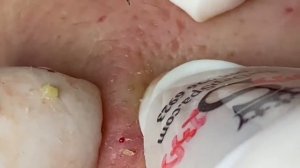 Выдавливание прыщей, угрей, черных точек и камедонов #319