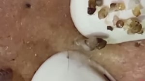 #223 Чистка лица от угрей и акне. Выдавливание прыщей. Удаление черных точек и комедонов