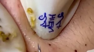 #225 Чистка лица от угрей и акне. Выдавливание прыщей. Удаление черных точек и комедонов