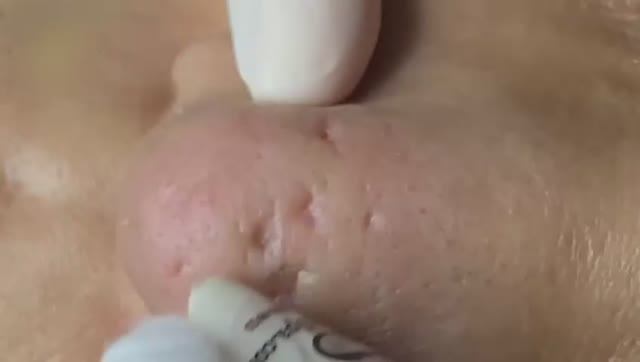 Удаление стойких комедонов