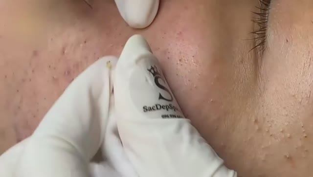 Asmr. Удаляем прыщи, комедоны и сальные пробки.